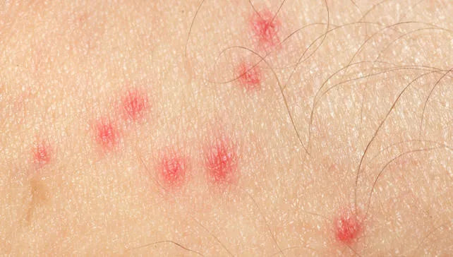 Bites that don't heal cleanly