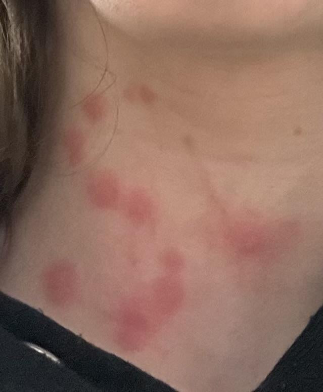 Welts you can't trace